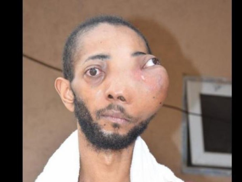 Man with cancerous facial tumour grateful despite falling short of target