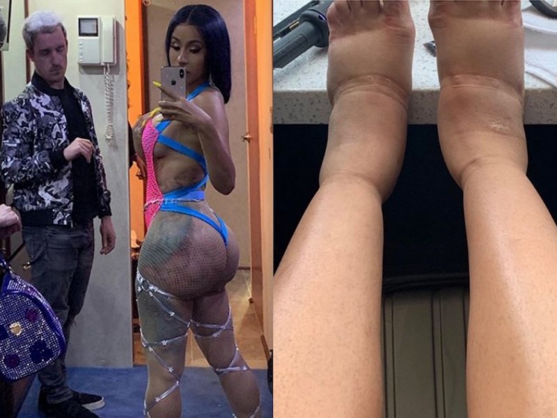 Cardi B Shares Her Plastic Surgery Side Effects Photos Left Fans Shook